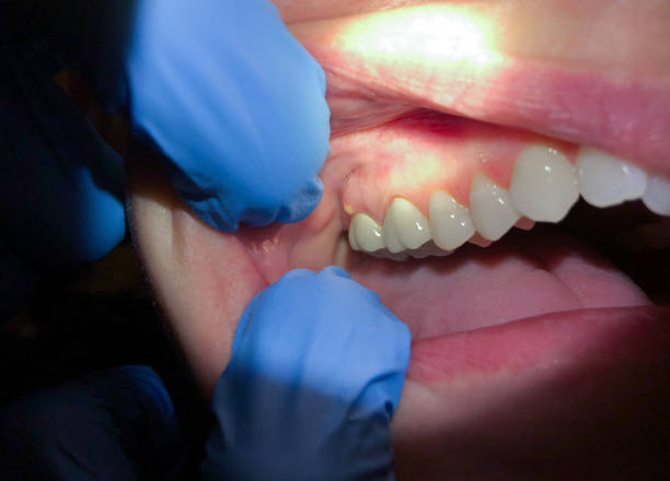 Best Dentist for Tooth Abscess  in Parsons, KS